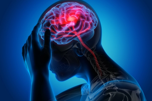 The Connection Between Partial Onset Seizures and Traumatic Brain Injury